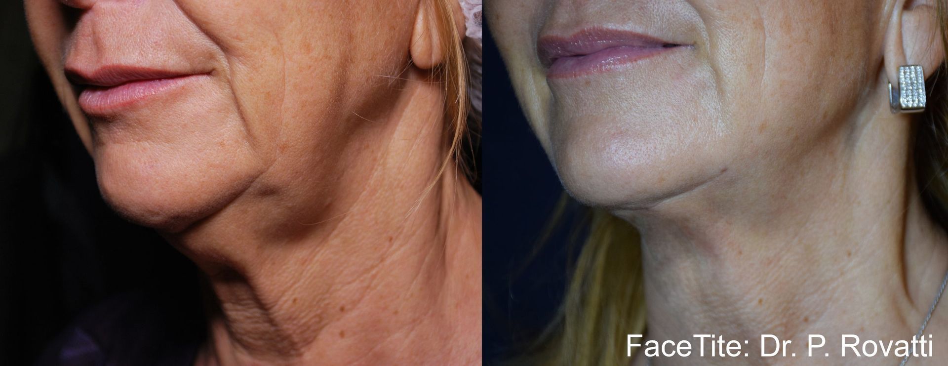 a patient shown before and after FaceTite treatment