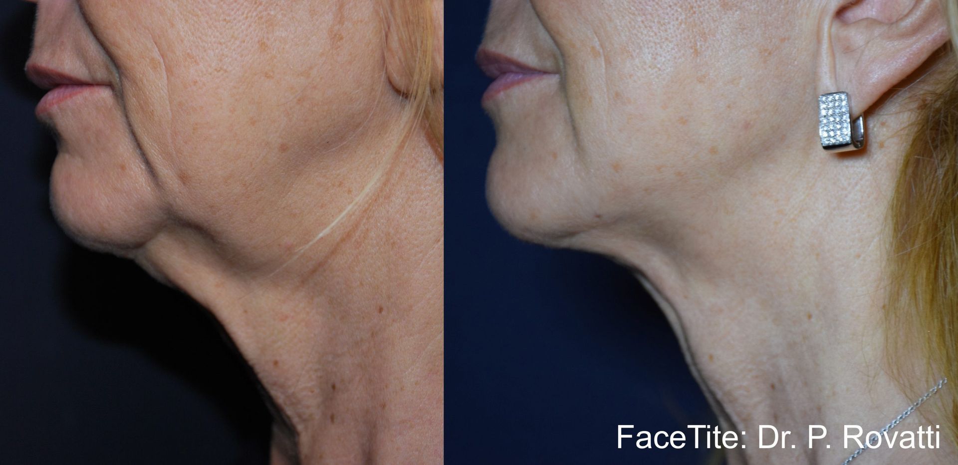 a patient shown before and after FaceTite treatment