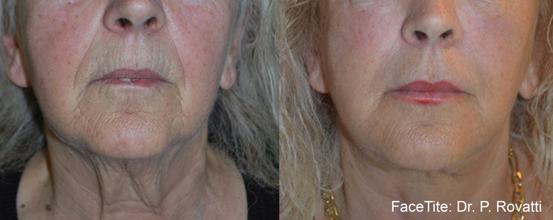 a patient shown before and after FaceTite treatment