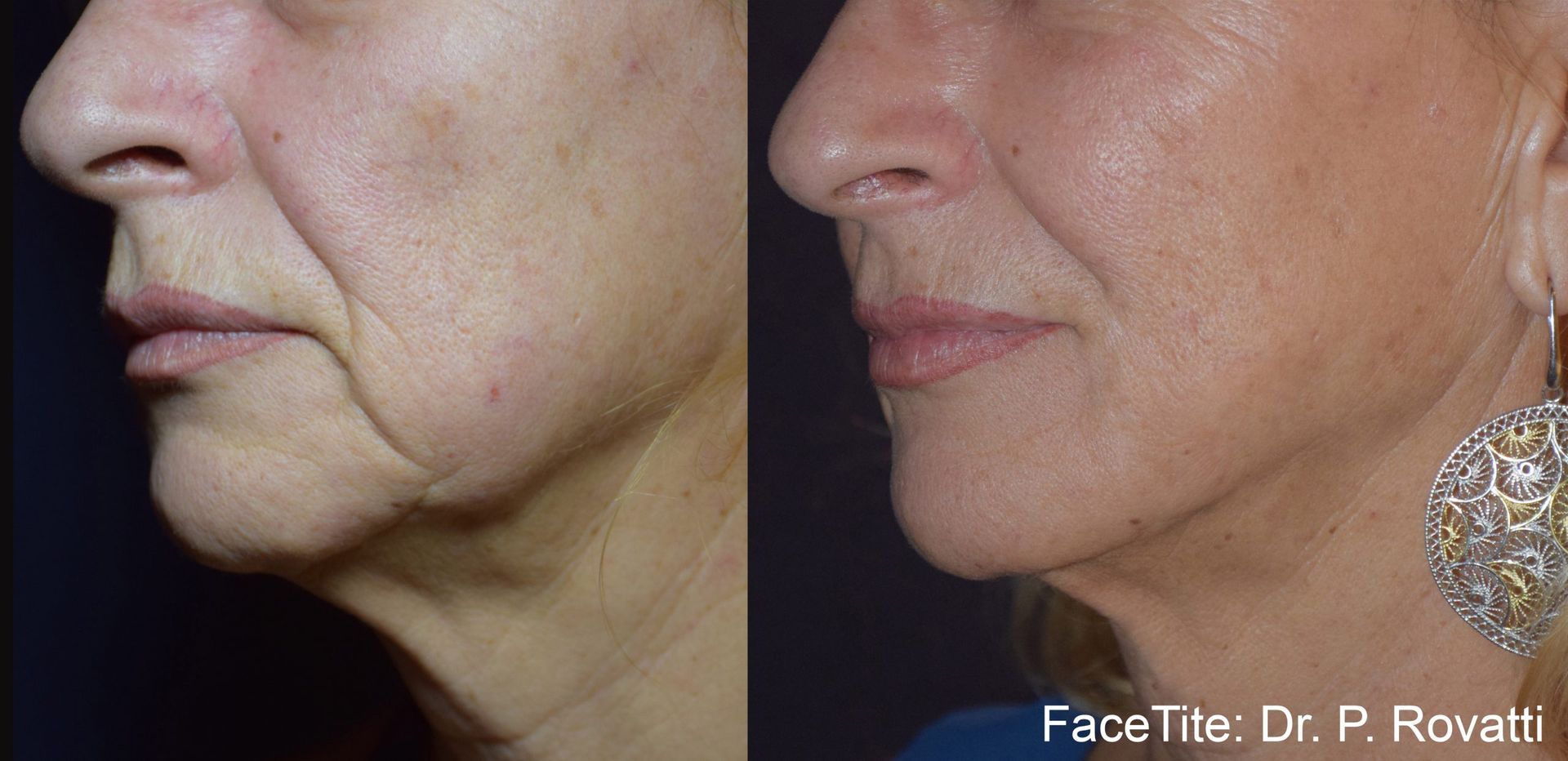 a patient shown before and after FaceTite treatment