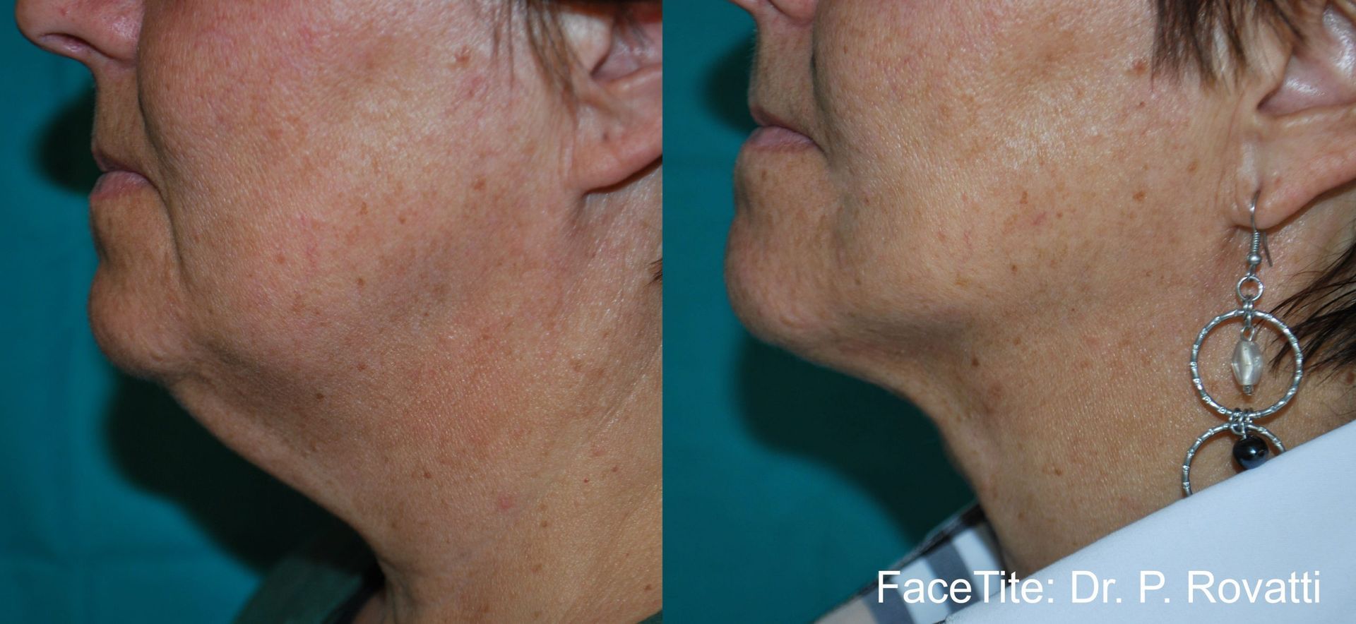 a patient shown before and after FaceTite treatment