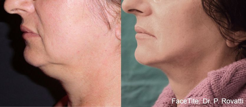 a patient shown before and after FaceTite treatment