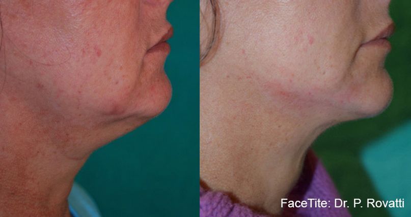 a patient shown before and after FaceTite treatment