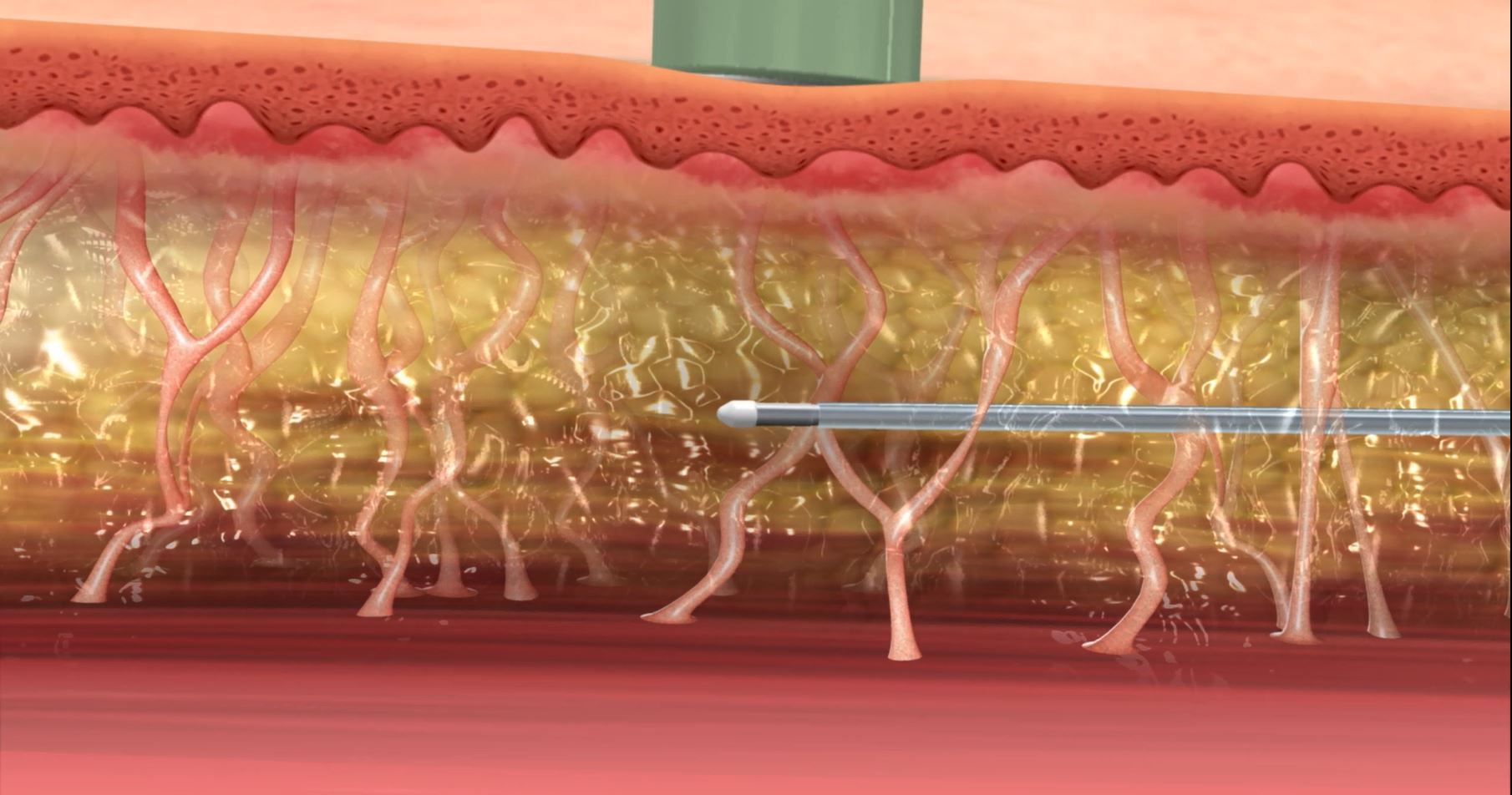 animated graphic demonstrating FaceTite treatment