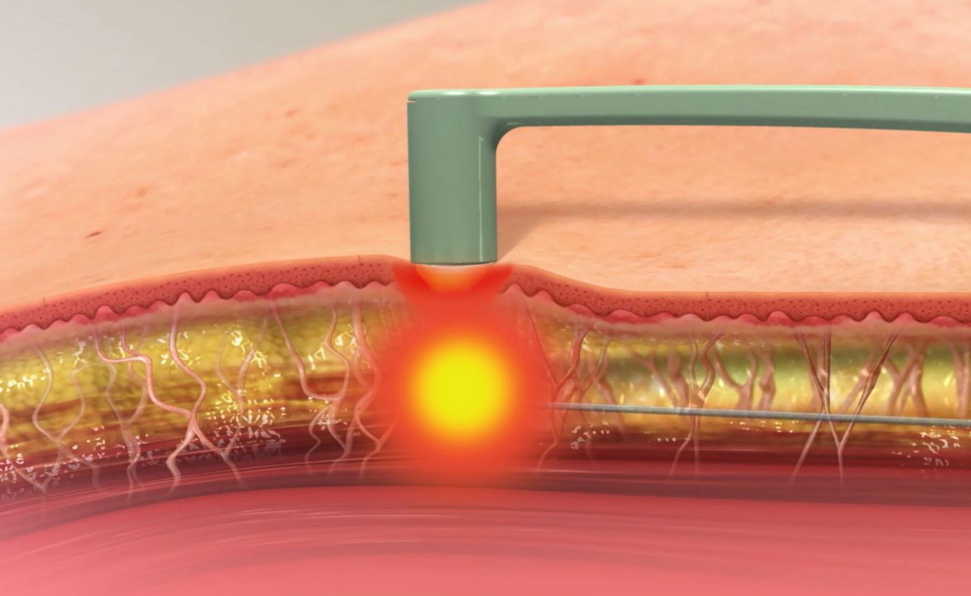 animated graphic demonstrating FaceTite treatment