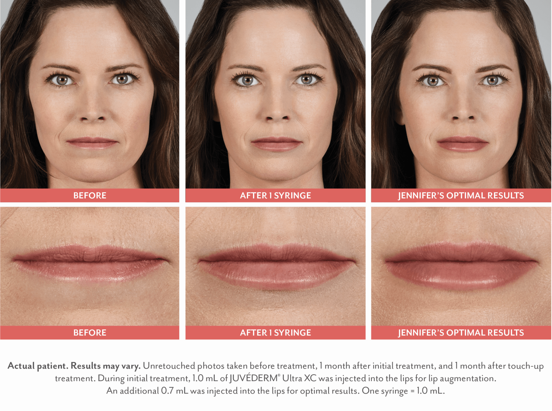 patient before and after treatment with the Juvederm collection of fillers