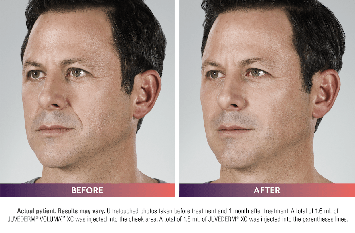 Before and after  - Dermal Fillers - Juvederm - Male