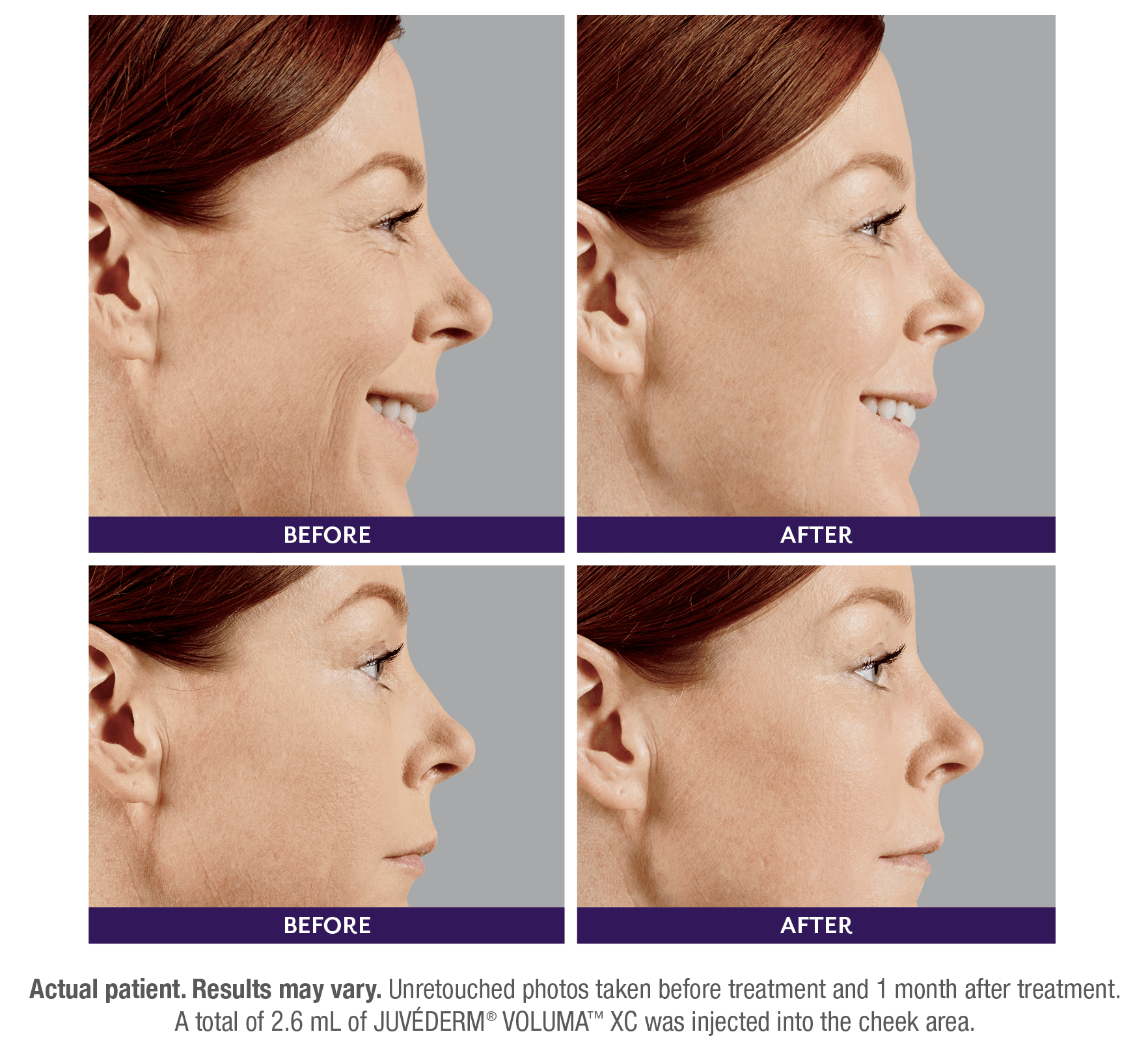 Before and after  - Dermal Fillers - Juvederm - woman smiling