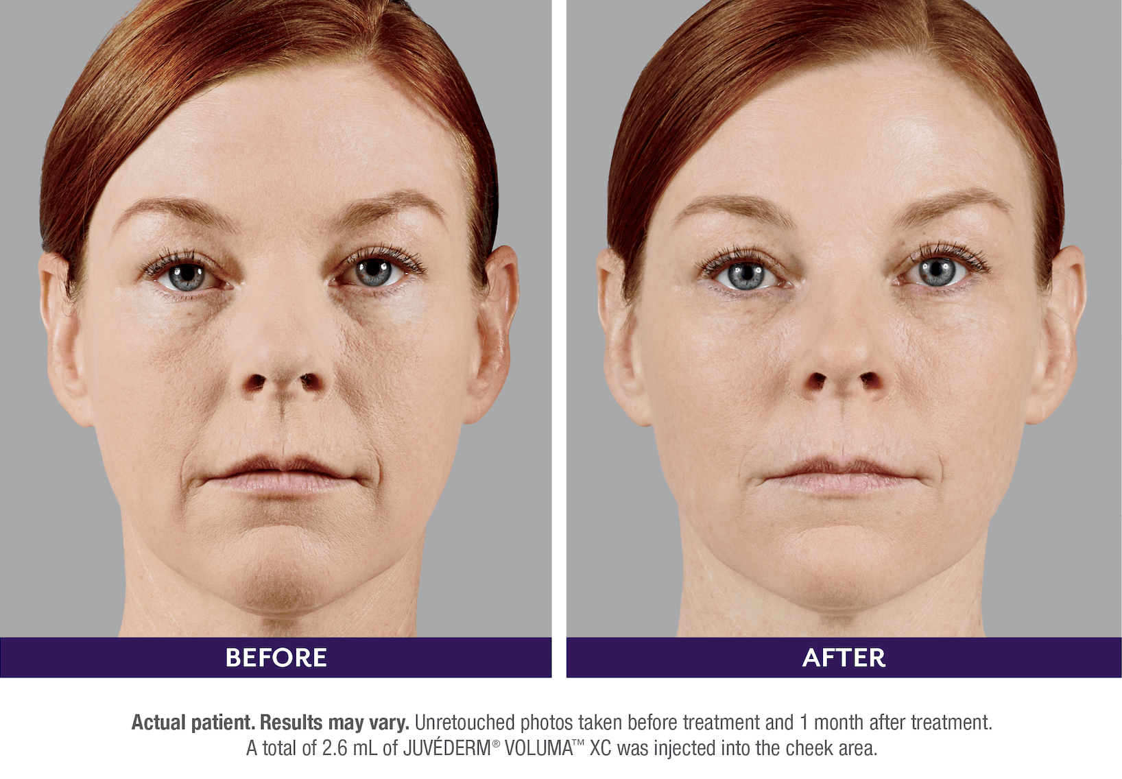 Before and after - Juvederm - Woman