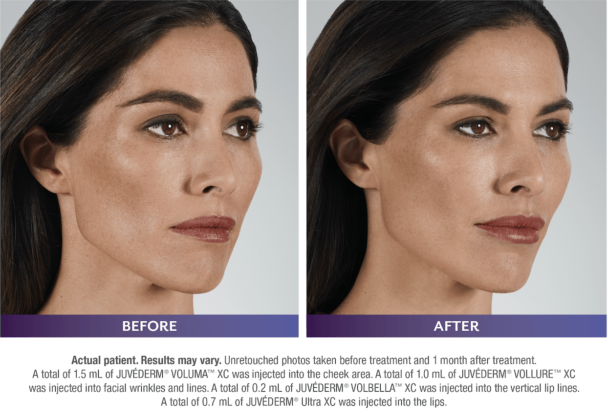 Before and after  - Dermal Fillers - Woman - Before and After