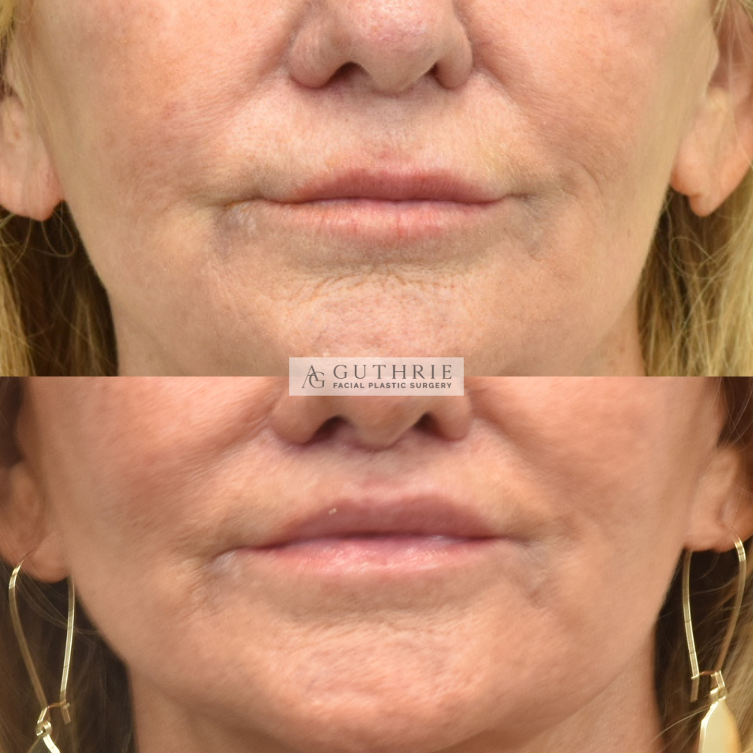 Before and After Subnasal Lip Lift
