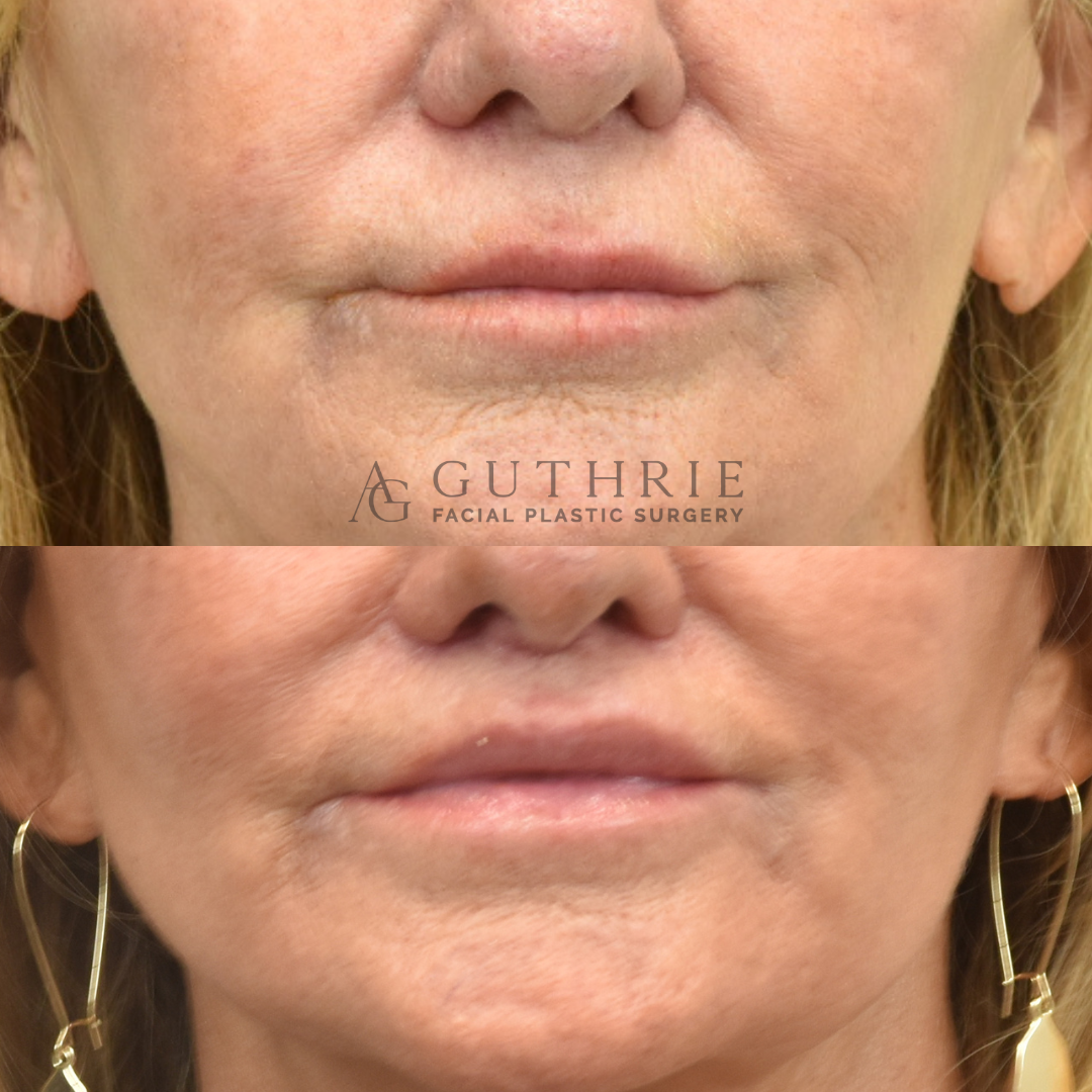Before and After Subnasal Lip Lift