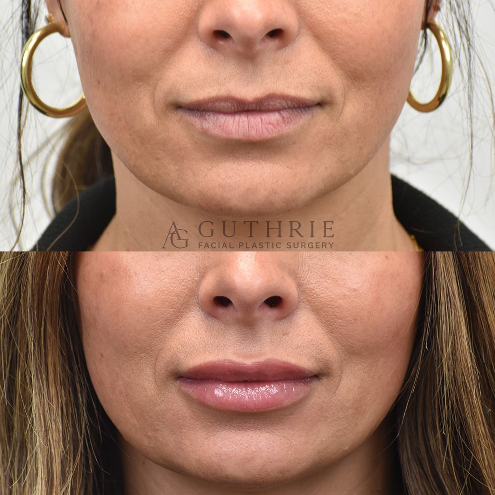 closeups of a woman's face shown before and after lip fillers treatment