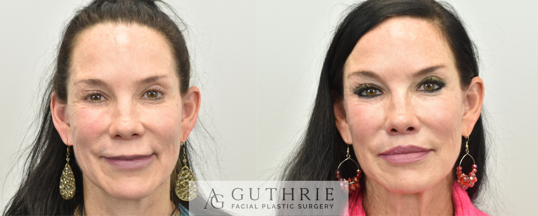 woman before and after lip lift procedure