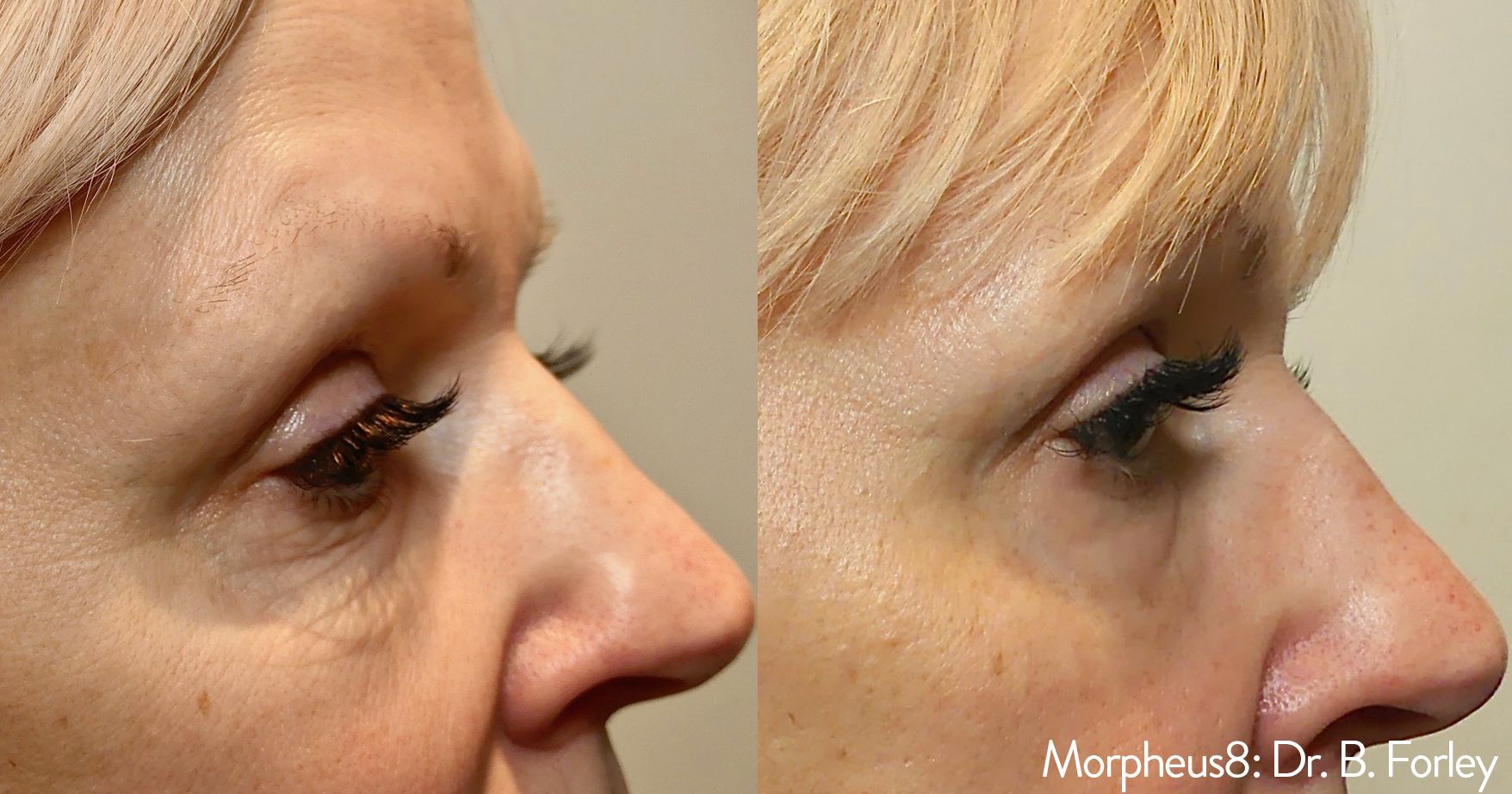 a patient before and after Morpheus8 treatment