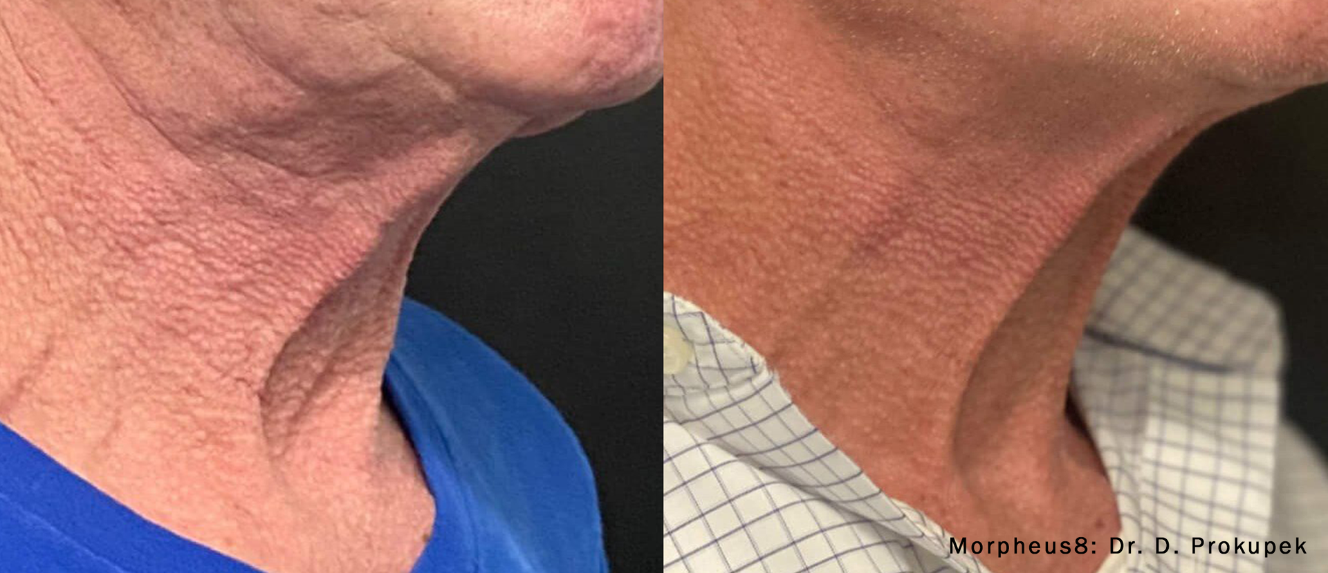 a man's neck Before and After Morpheus8 Treatment