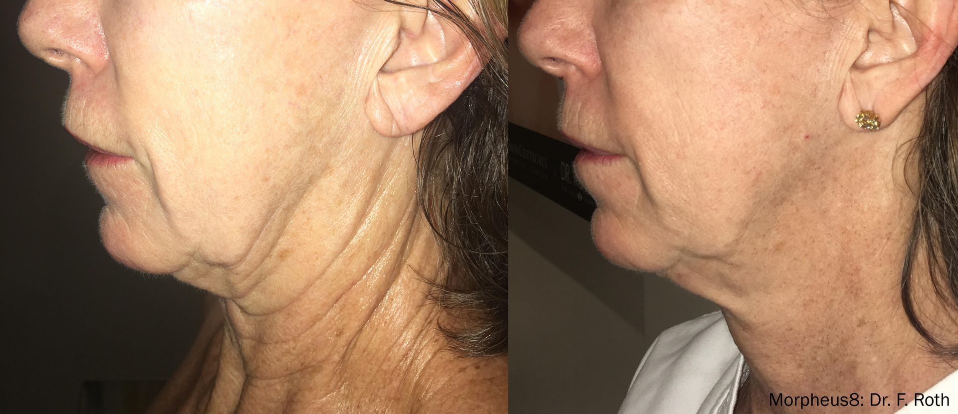 woman's lower face and neck Before and After Morpheus8 Treatment