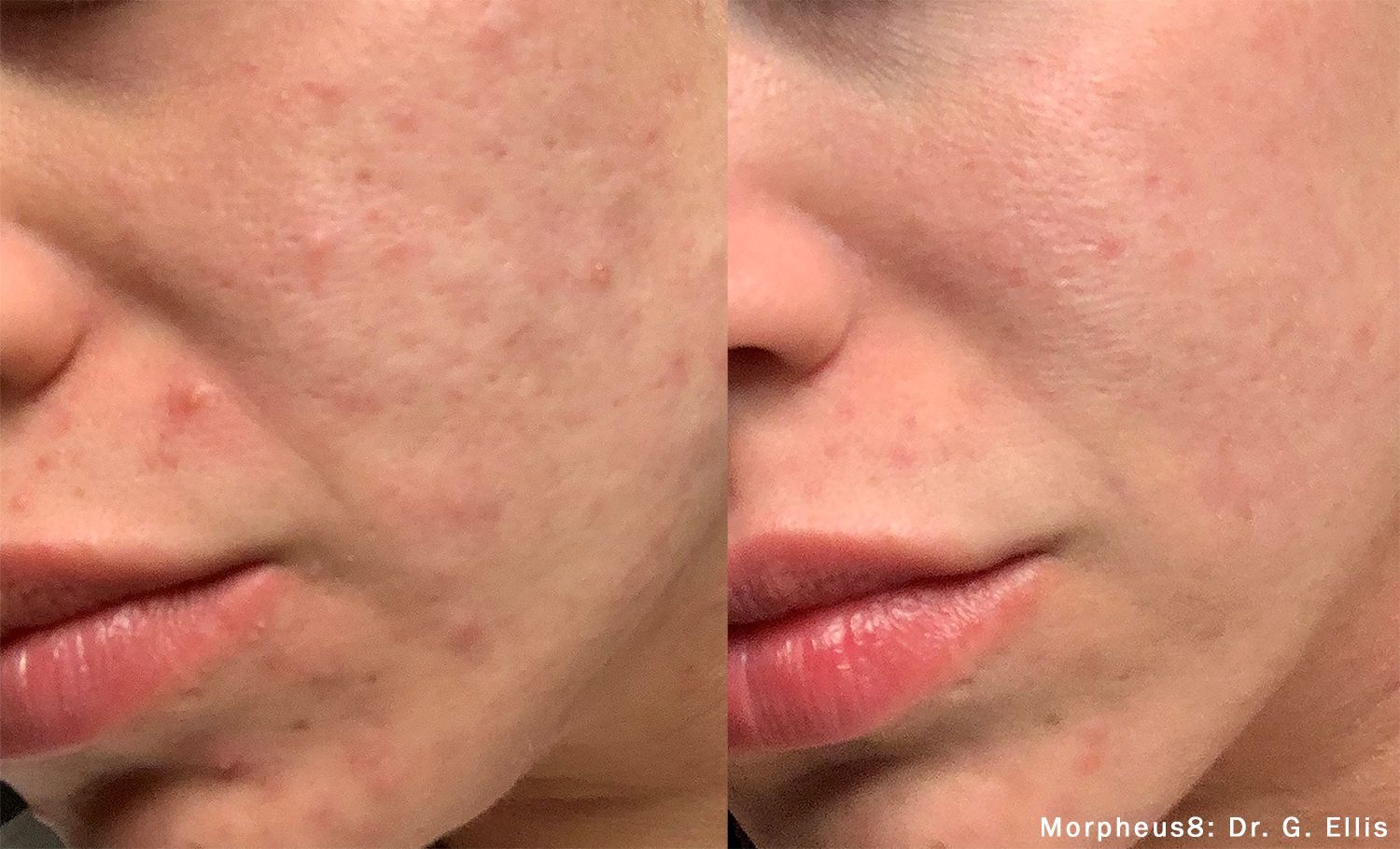 closeup of patient's cheeks before and after morpheus8 treatment for acne scars