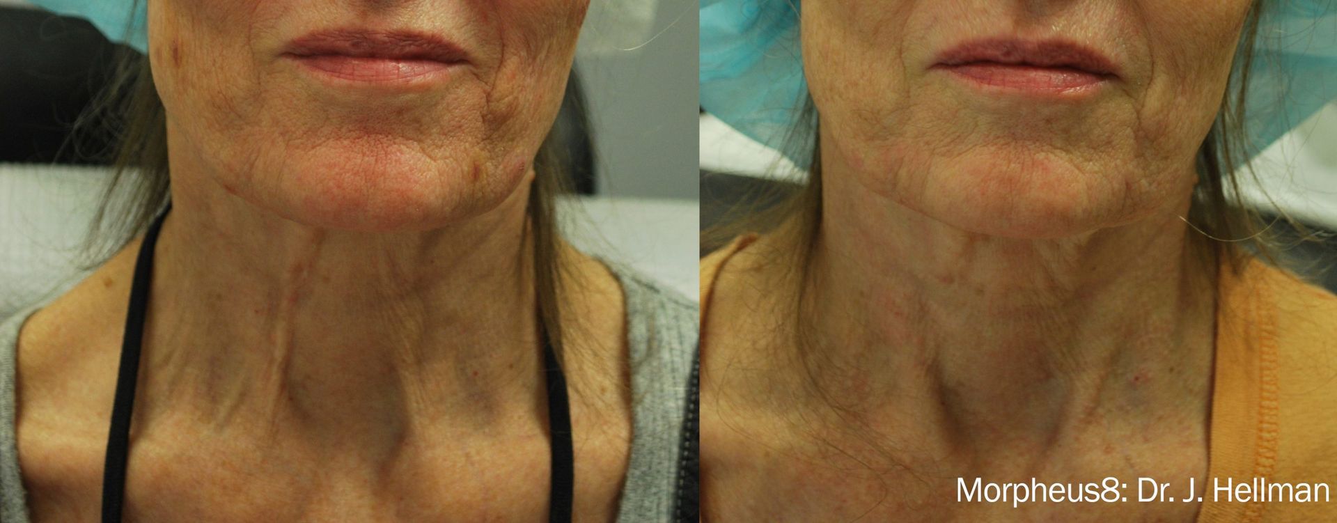 a woman's face before and after Morpheus8 treatment