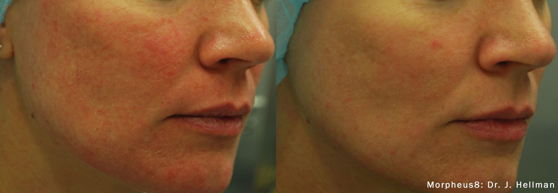 woman's lower face Before and After Morpheus8 Treatment