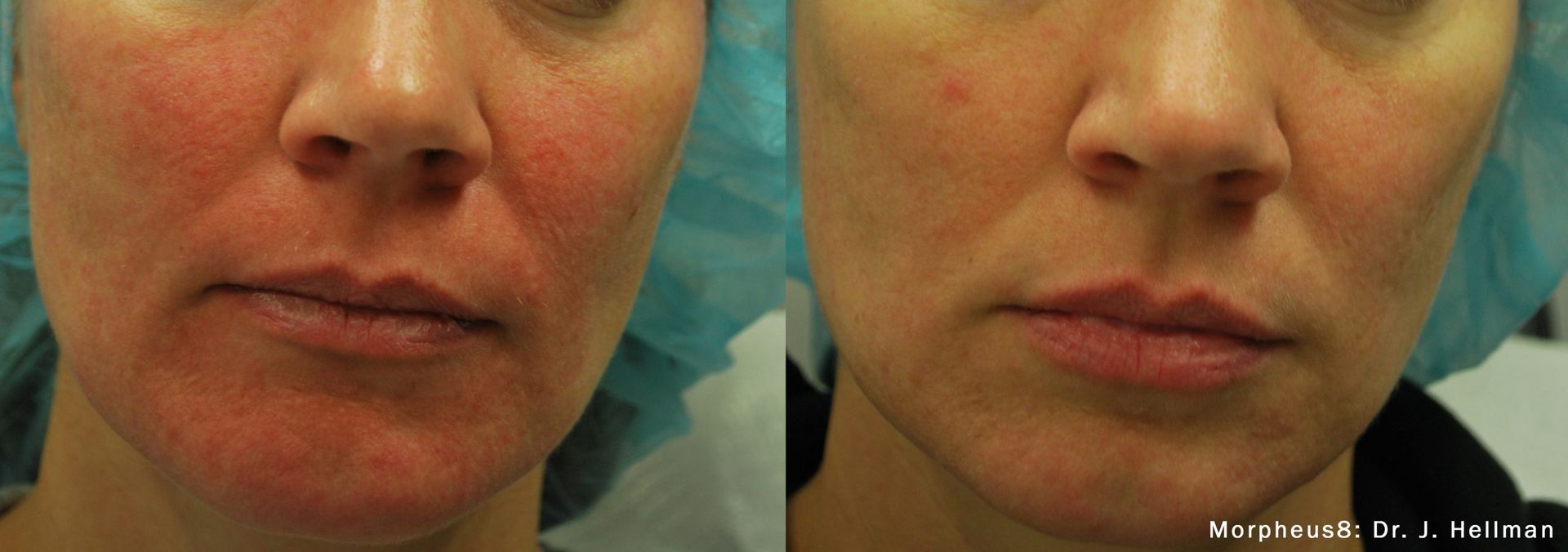 a woman's face before and after Morpheus8 treatment