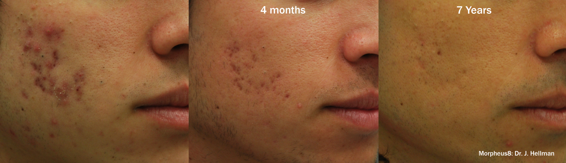 a man's face before and after Morpheus8 treatment