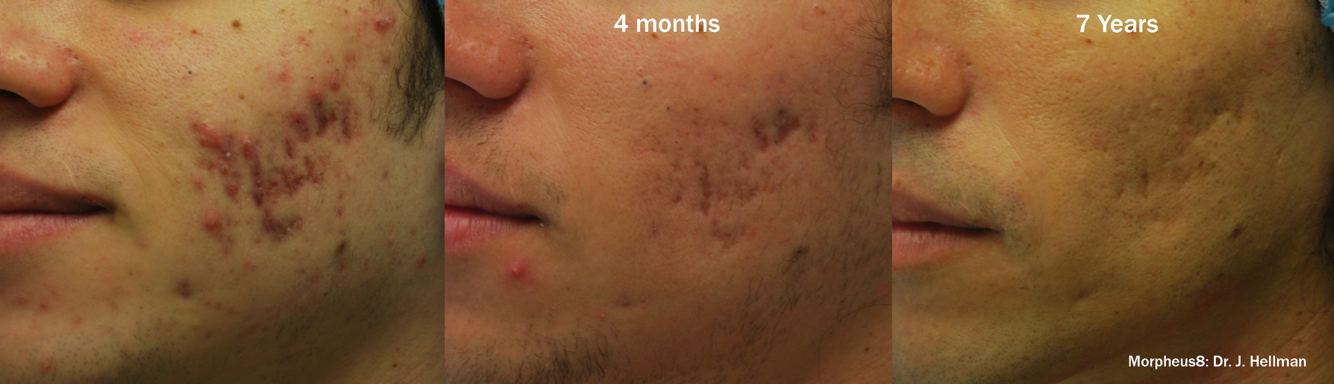 a man's face before and after Morpheus8 treatment