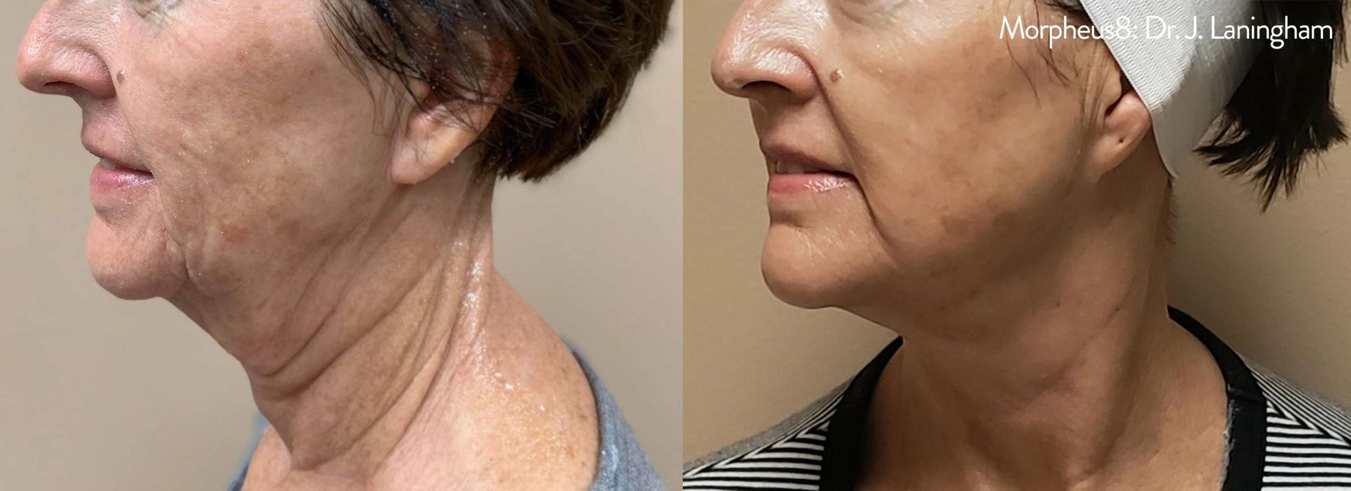 closeup of patient's face and neck before and after morpheus8 treatment