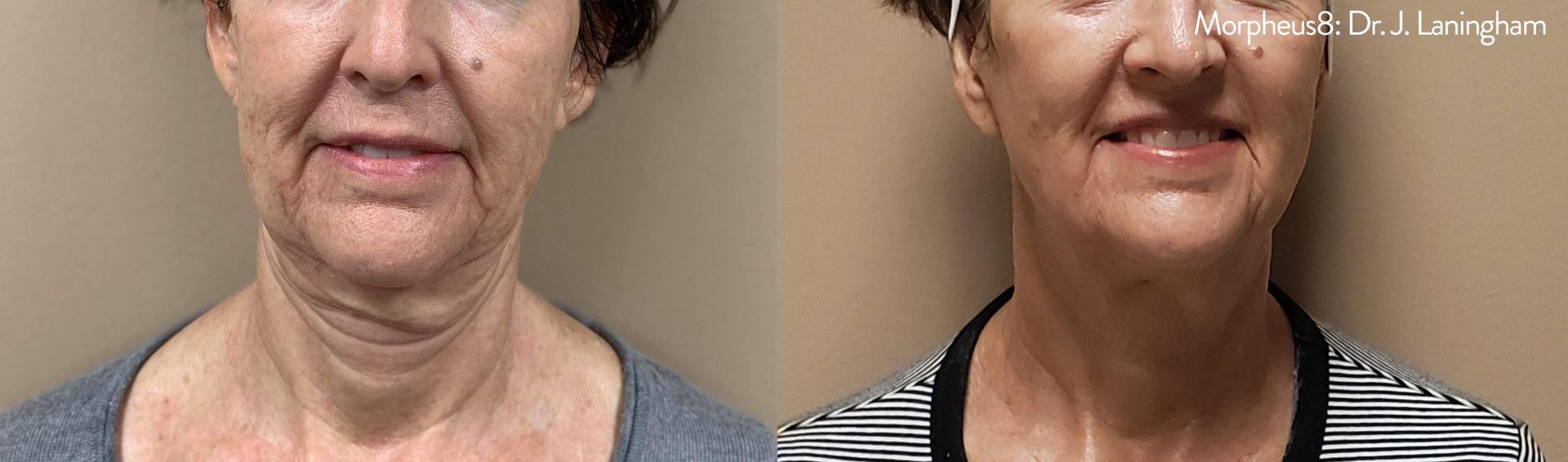 a woman's face before and after Morpheus8 treatment