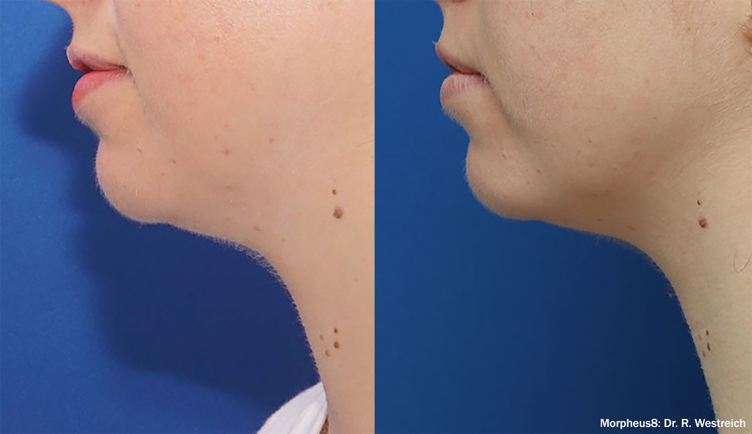 a woman's face before and after Morpheus8 treatment