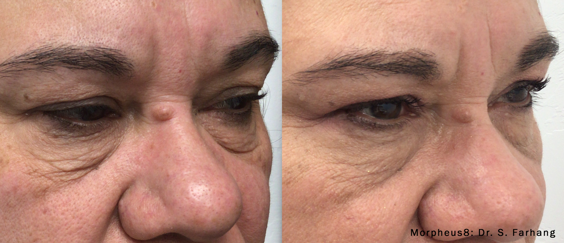 a patient before and after Morpheus8 treatment