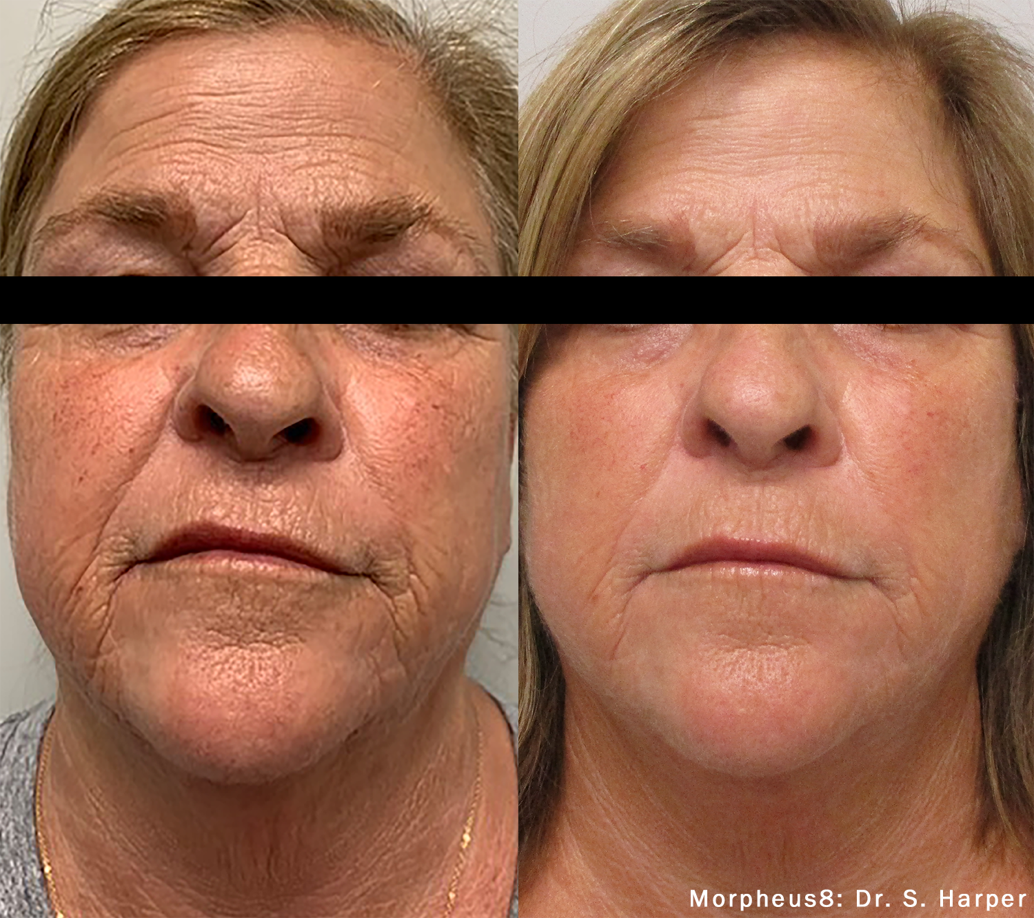 closeup of patient's face before and after Morpheus8 treatment