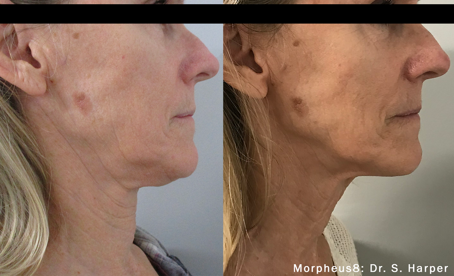 Before and After Morpheus8 Treatment