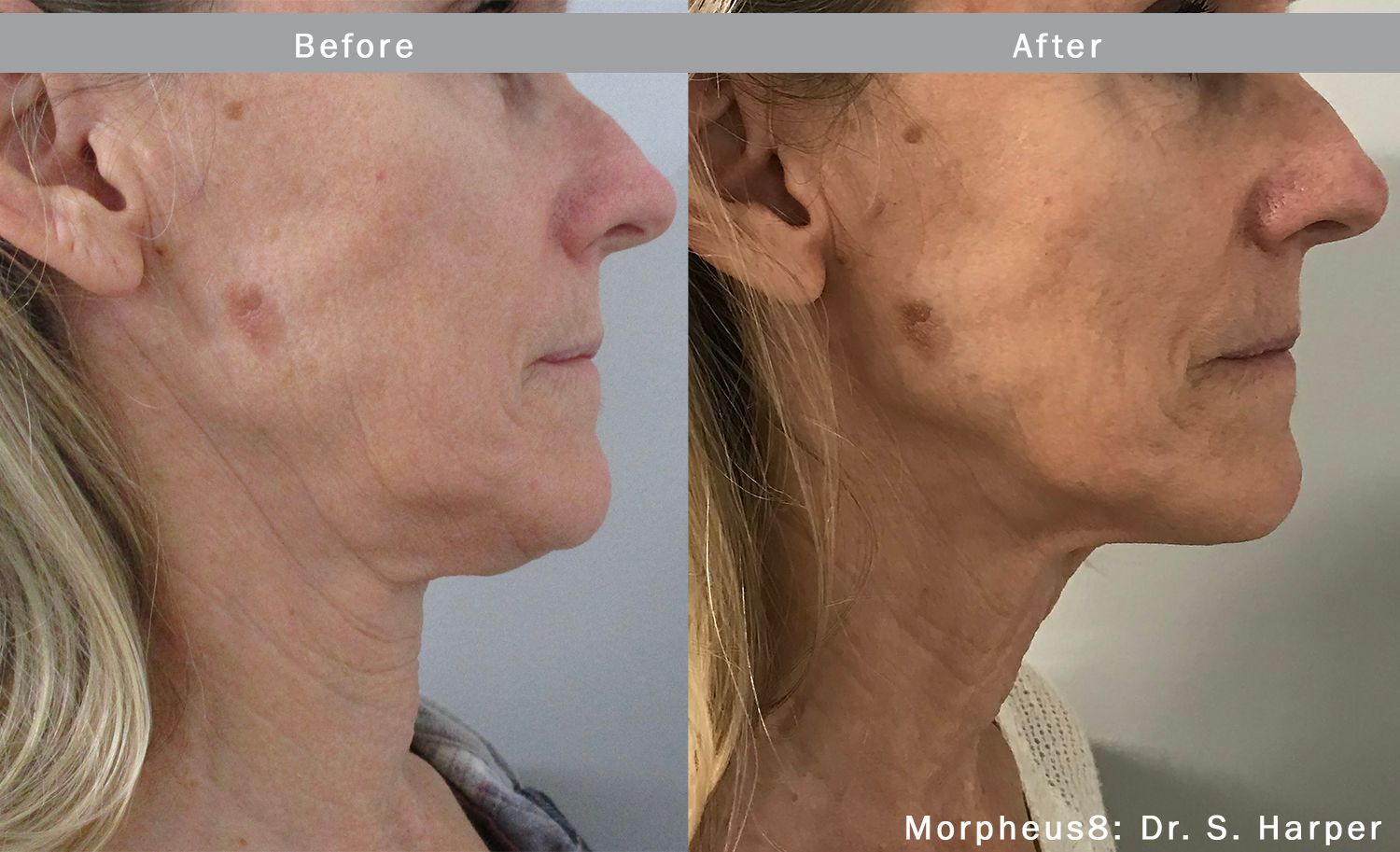 a woman's face before and after Morpheus8 treatment