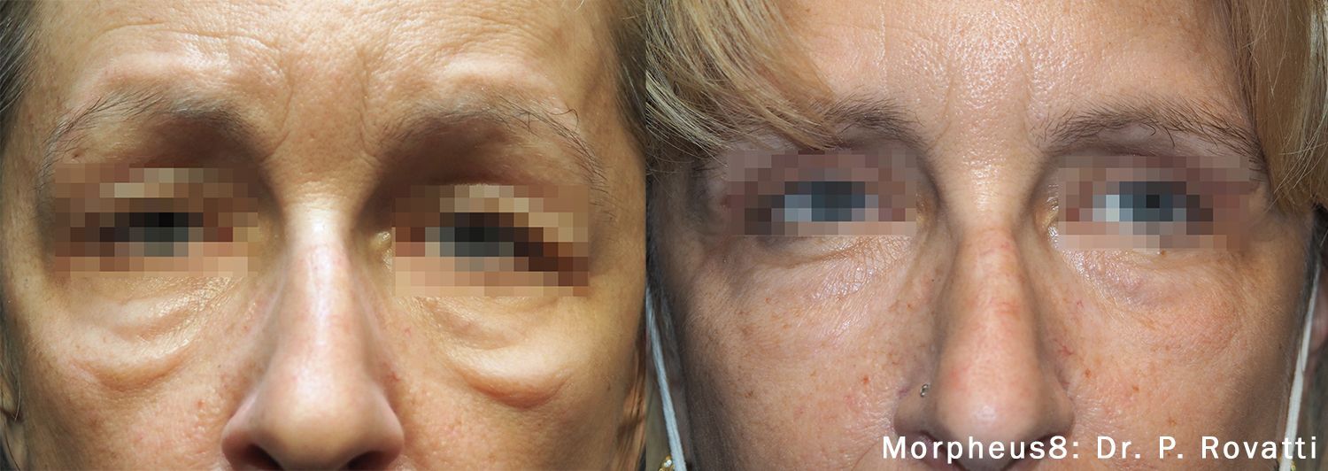 patient's face Before and After Morpheus8 Treatment