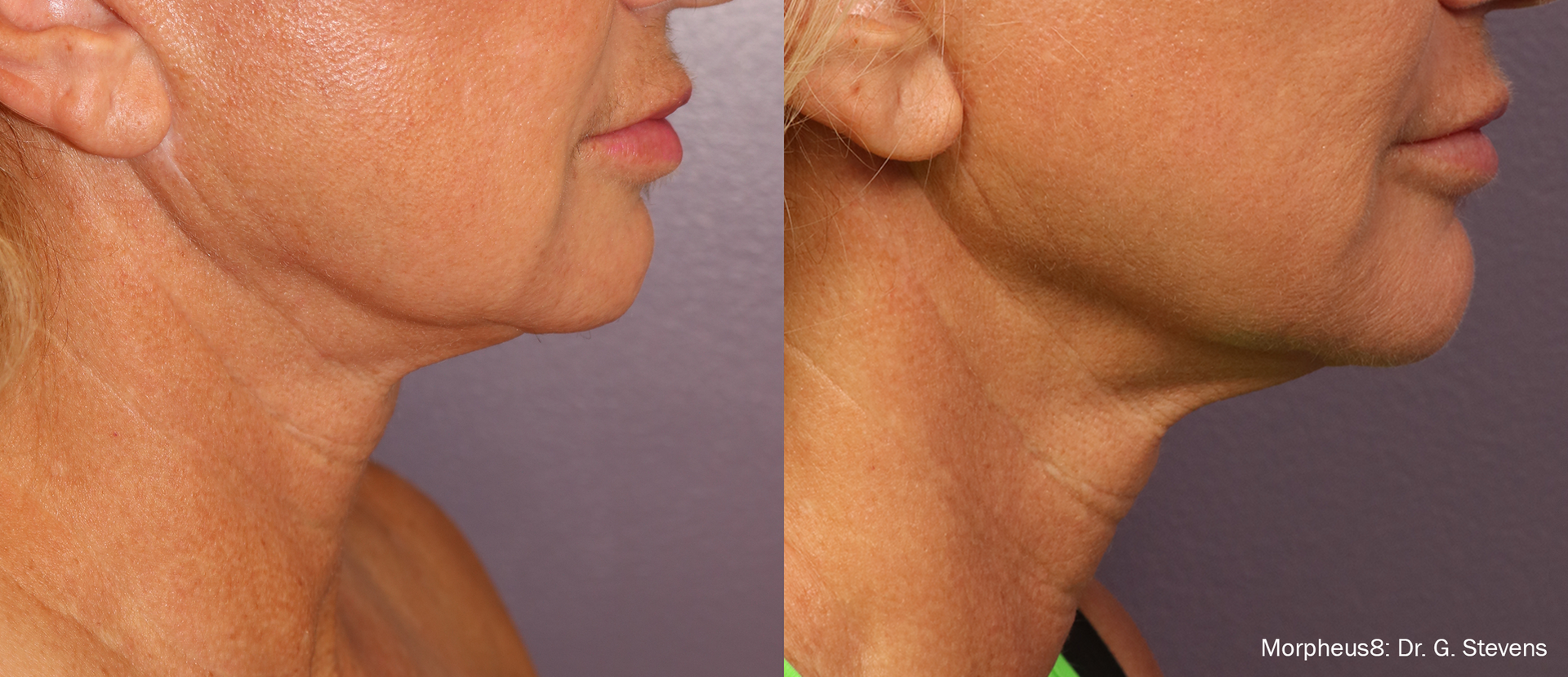 a woman's face before and after Morpheus8 treatment