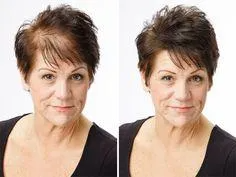 Woman with thinning hair, before and after a hair restoration. Black top, short brown hair, smiling.