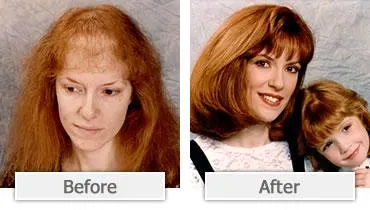 Before and after comparison of woman with thinning hair to woman with fuller hair.