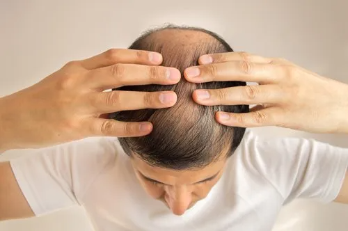 Man examining thinning hair on his head with hands.