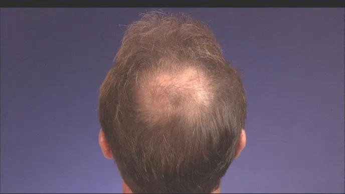 Back of a person's head showing thinning brown hair and balding scalp against a purple background.