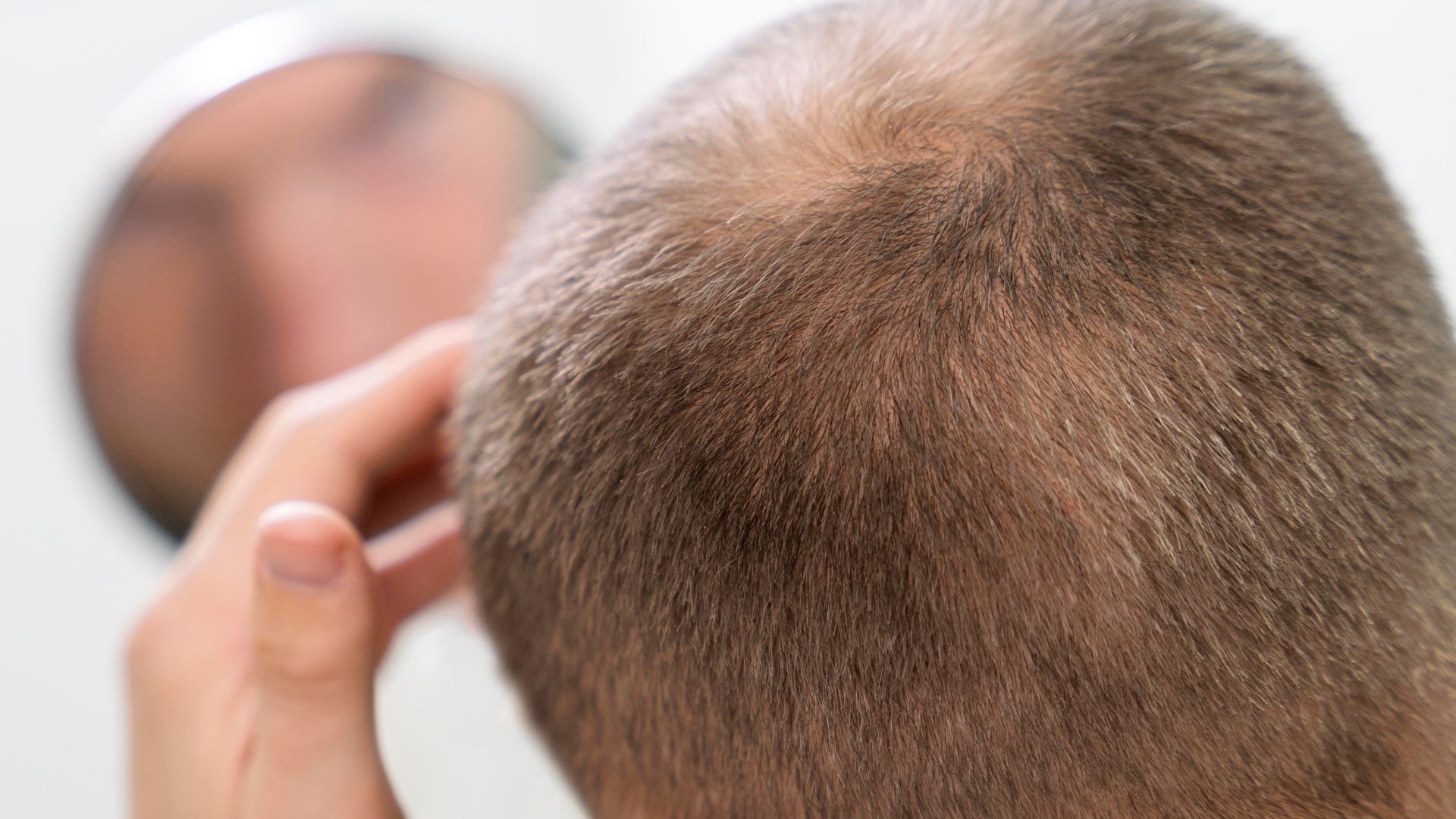 Can Mounjaro cause hair loss? Learn the facts about tirzepatide and hair thinning – and how to manage it.
