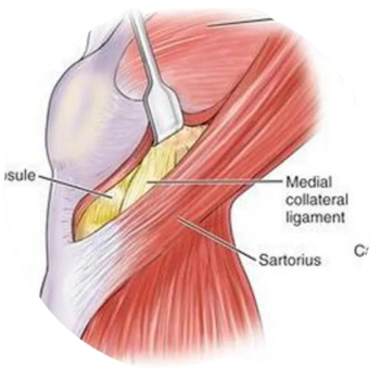 Jiffy Knee Exposure | AZ ORTHO Jiffy Knee Exposure | AZ ORTHO
