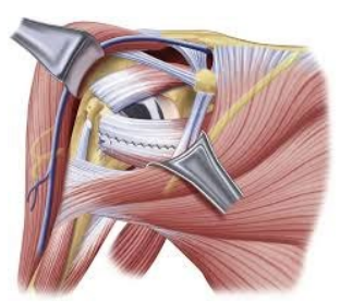 Sparing Approach 1 | AZ Ortho