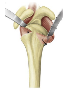 Sparing Approach 2 | AZ Ortho