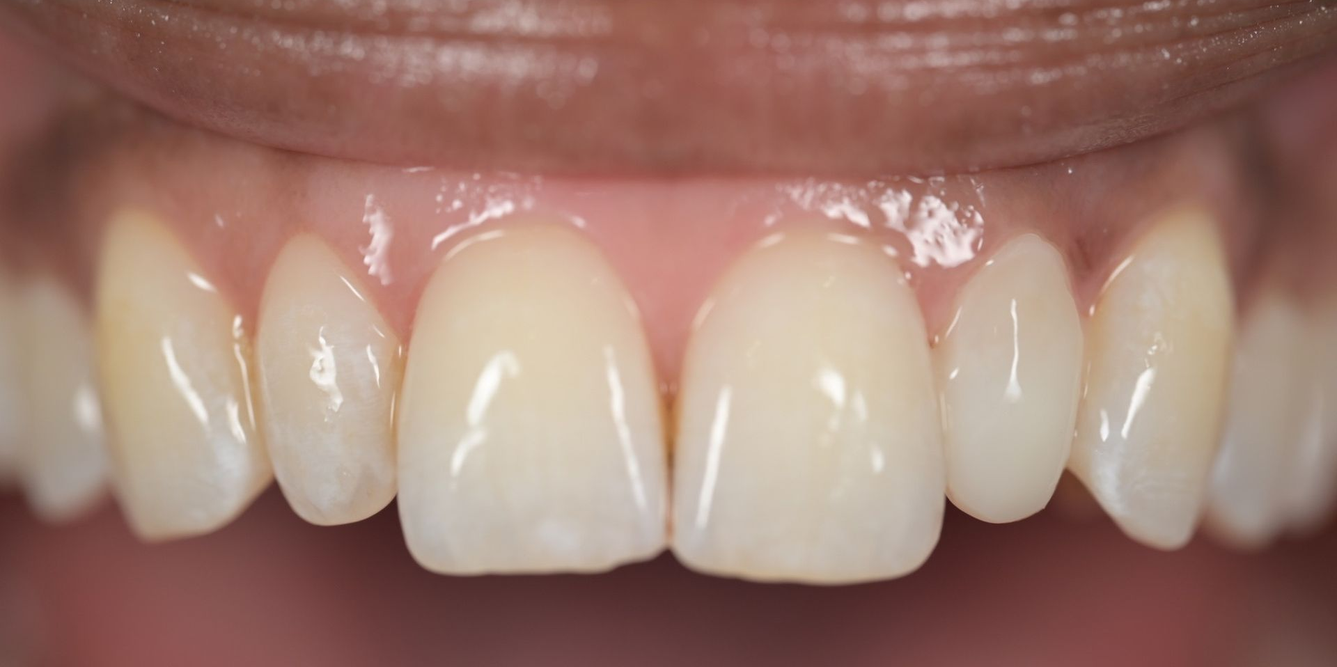 Close-up of teeth, center tooth chipped and discolored. Other teeth are white with visible vertical lines. Black background.