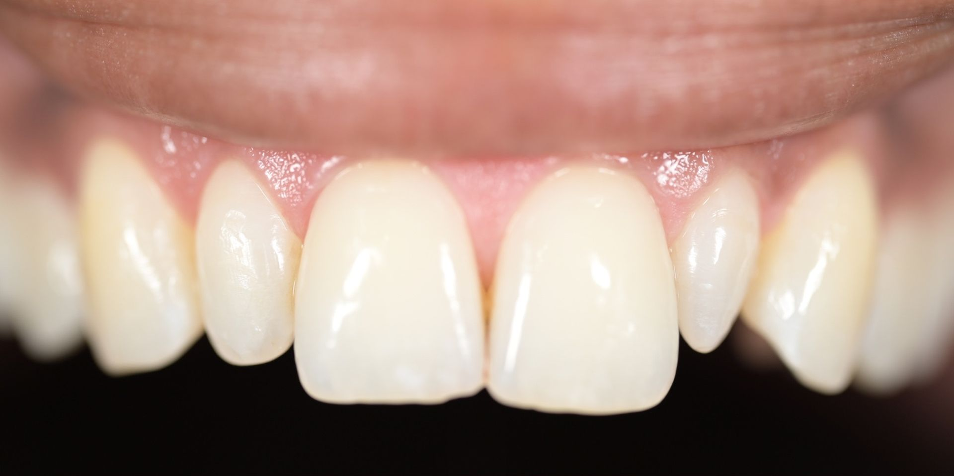 Close-up of teeth. The front teeth are light-colored and appear to be well-maintained, with a pink gum line.