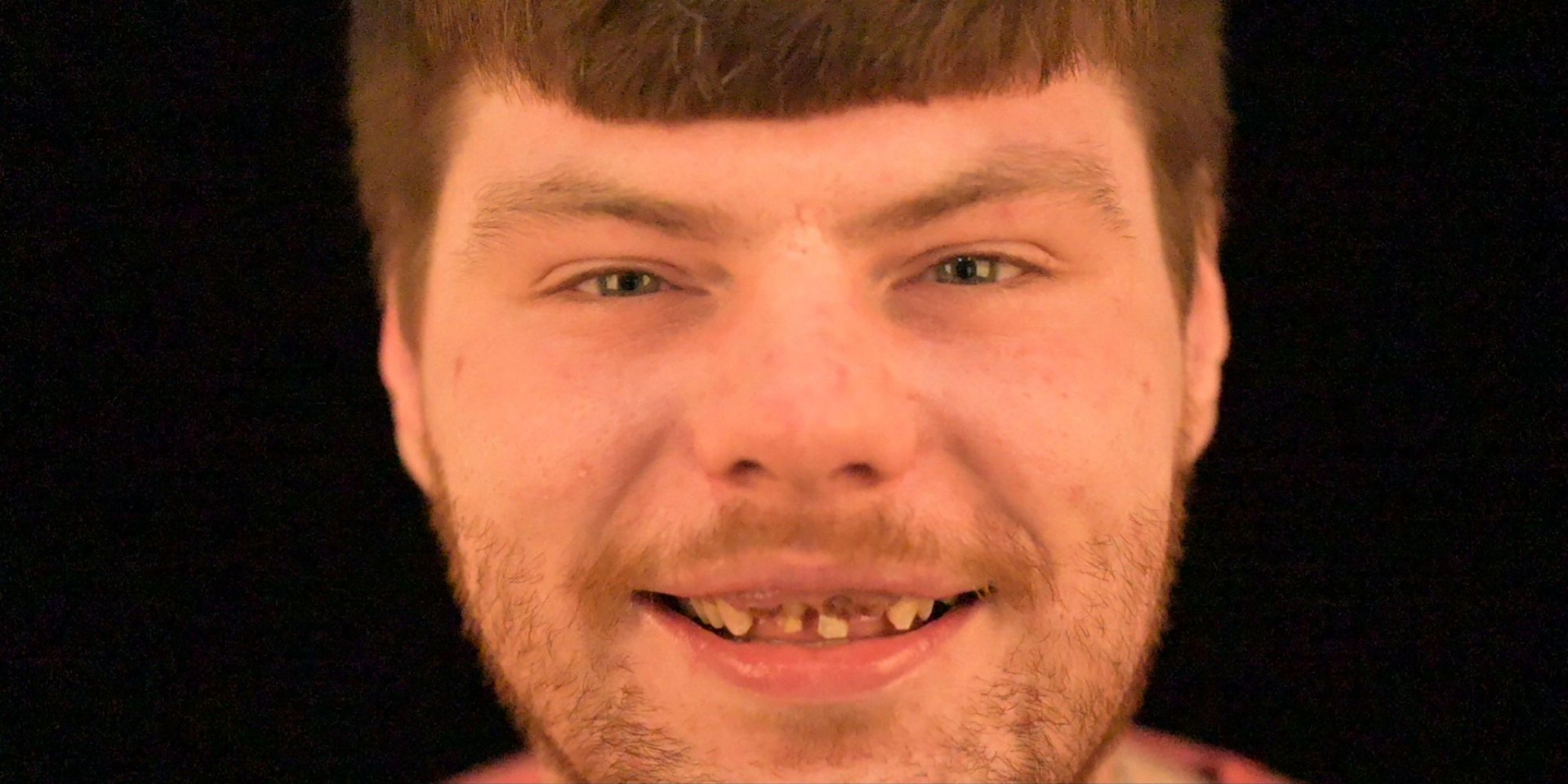 Close-up of a person's teeth, showing a slight discoloration of one tooth and visible lips.