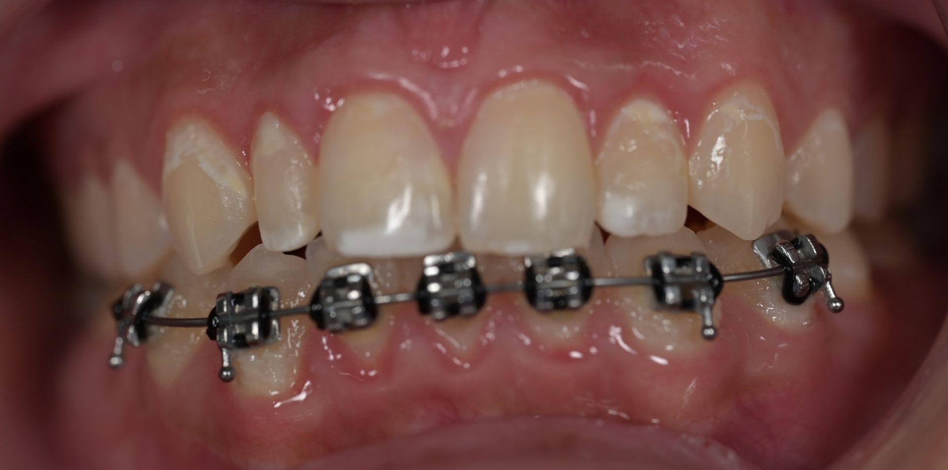 Close-up of a person's teeth, showing a slight discoloration of one tooth and visible lips.