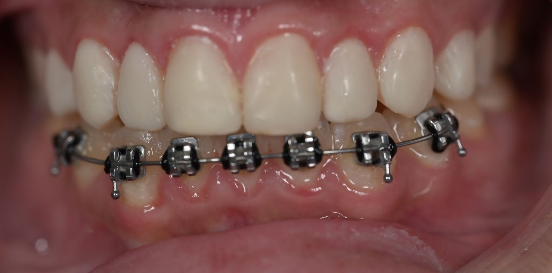 Close-up of human teeth, showing a row of upper teeth with visible gums and lips.