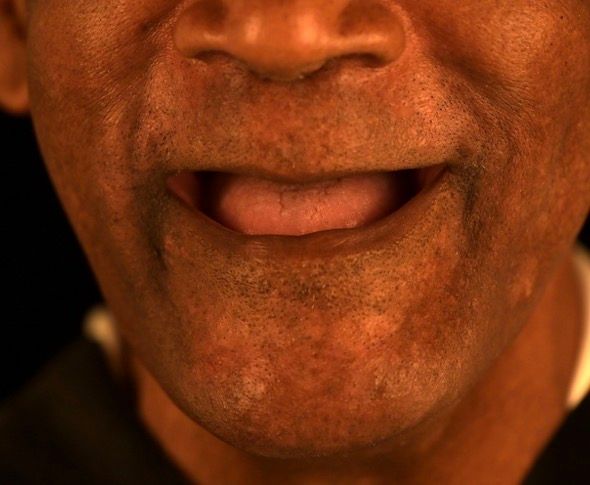 Close-up of teeth, center tooth chipped and discolored. Other teeth are white with visible vertical lines. Black background.